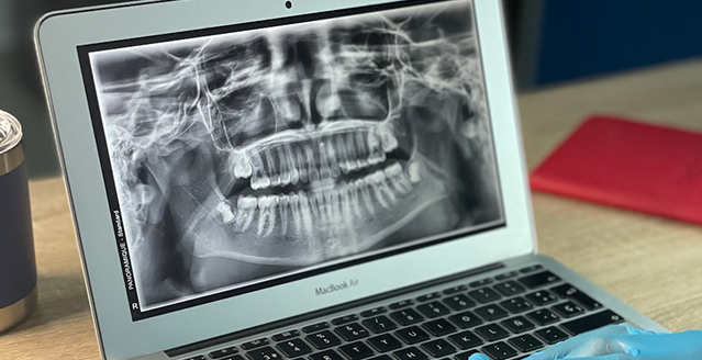 A dental X-ray is displayed on a laptop screen on a wooden desk, alongside a blue cup, red notebook, and a gloved hand, suggesting a clinical setting.